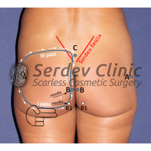 Scarless Buttock Lift by Suture Instructions + Video