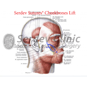 Cheekbone SMAS Lift and Volume Creation Instructions + Video