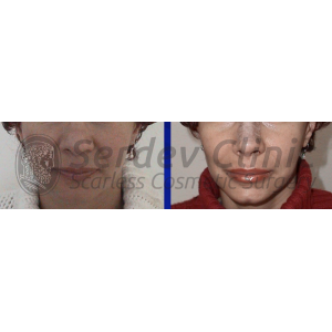 Dimple Formation in Chin Instructions + Video