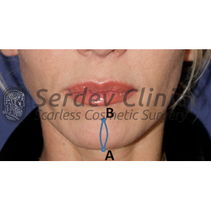 Chin Enhancement & Correction Instructions + Video
