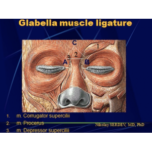 Glabella Muscle Ligation Instructions + Video