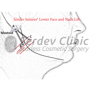 Lower SMAS Face and Neck Lift Instructions + Video