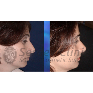 Nasal Tip Rotation Instructions + Video