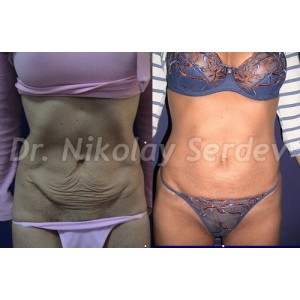 Abdominal Flaccidity Tightening Instructions + Video