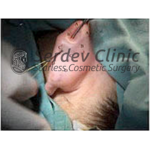 Scarless Method in Prominent Ears Instructions + Video