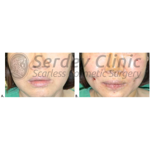 Dimple Formation in Smiling Point Instructions + Video